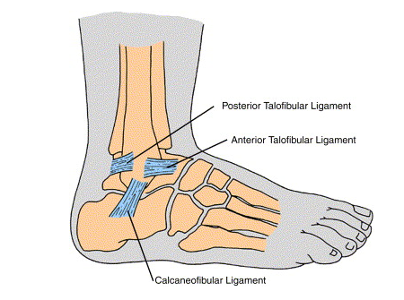 grade 3 ankle sprain